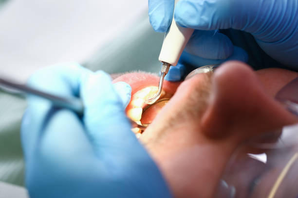 Best Emergency Root Canal Treatment in Great Falls Crossing, VA